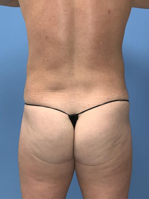 Liposuction Before & After Image