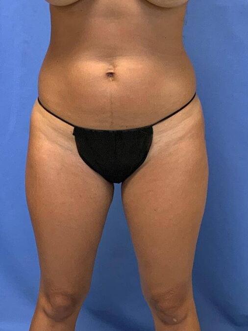 Liposuction Before & After Image