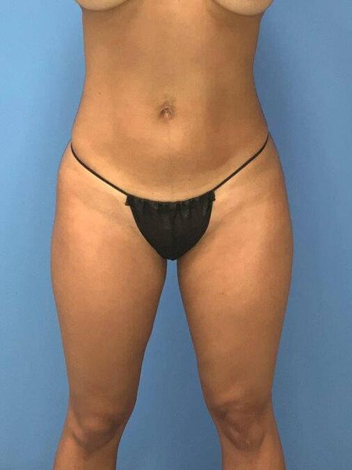 Liposuction Before & After Image