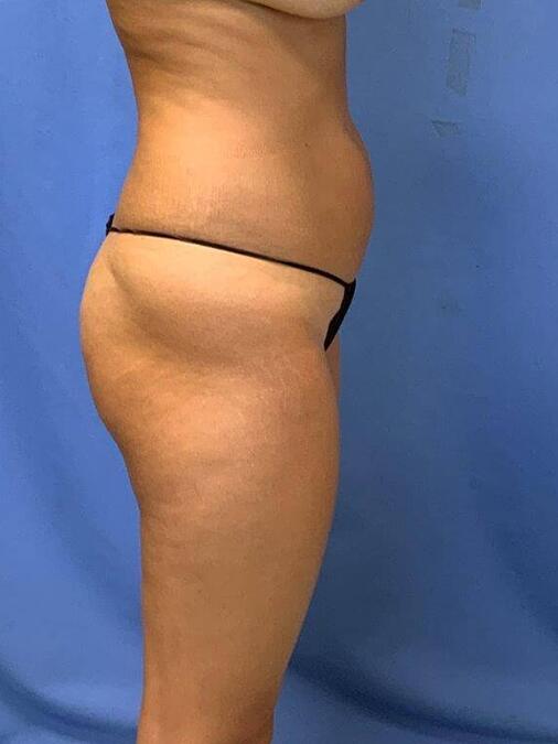Liposuction Before & After Image