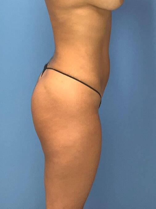 Liposuction Before & After Image