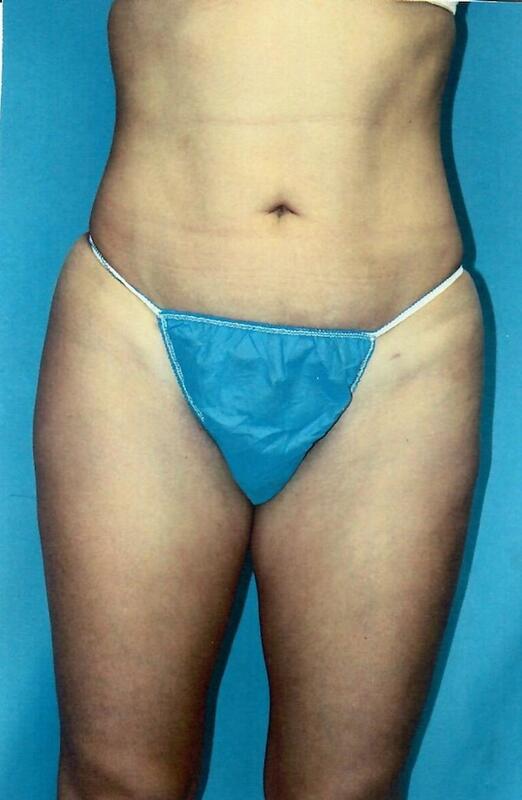 Liposuction Before & After Image