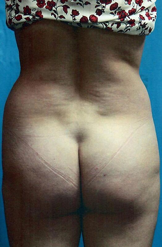 Liposuction Before & After Image