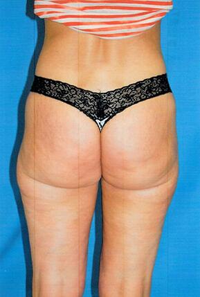 Liposuction Before & After Image