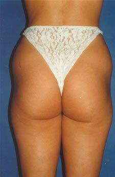 Liposuction Before & After Image