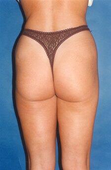 Liposuction Before & After Image