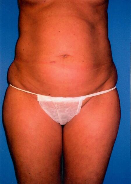 Liposuction Before & After Image