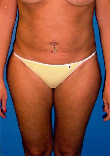 Liposuction Before & After Image