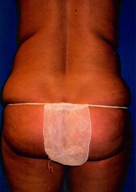 Liposuction Before & After Image