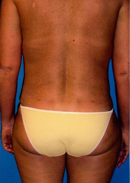 Liposuction Before & After Image