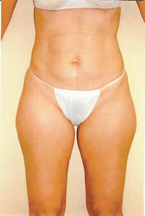 Liposuction Before & After Image