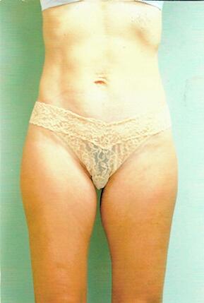 Liposuction Before & After Image