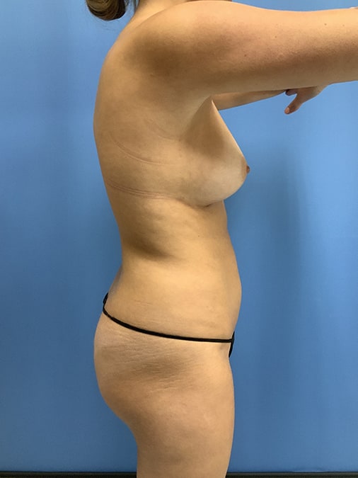 Liposuction Before & After Image