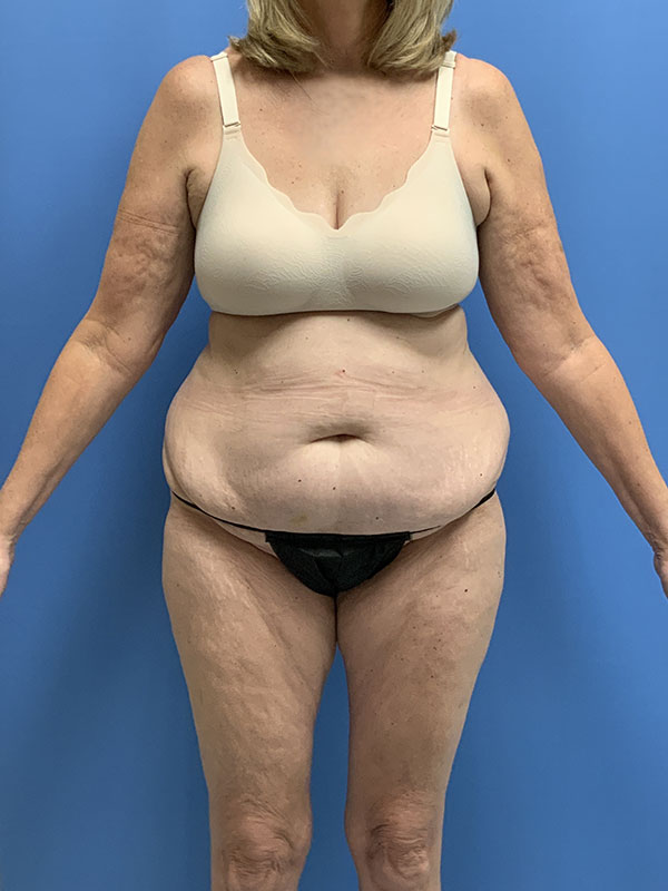 Liposuction Before & After Image