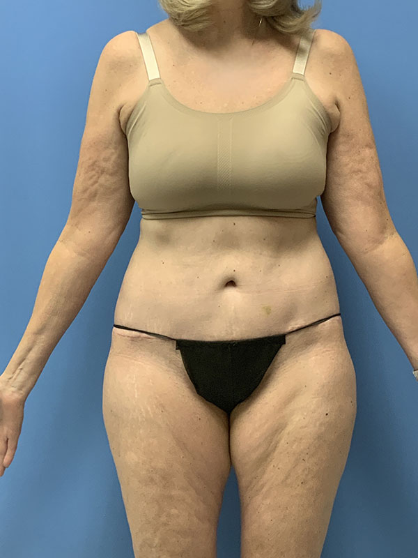 Liposuction Before & After Image