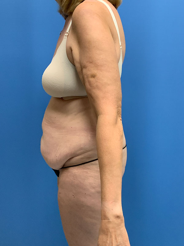 Liposuction Before & After Image
