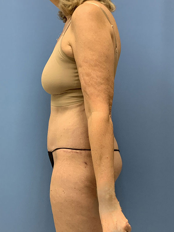 Liposuction Before & After Image