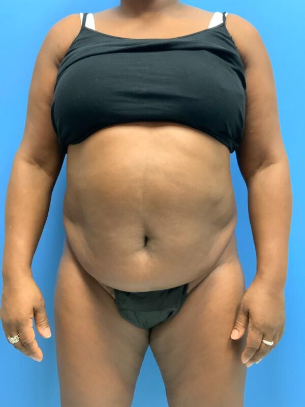 Tummy tuck Before & After Image