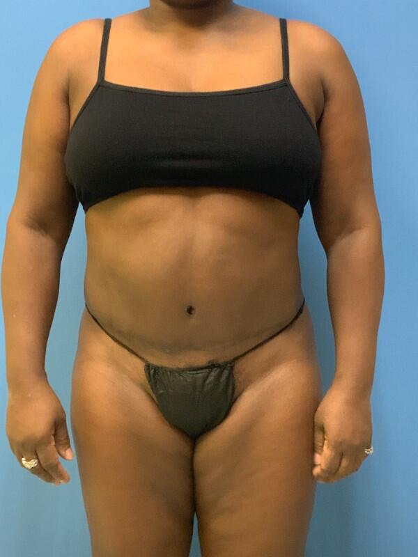 Tummy tuck Before & After Image