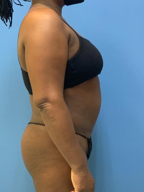 Tummy tuck Before & After Image