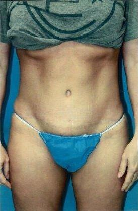 Tummy tuck Before & After Image