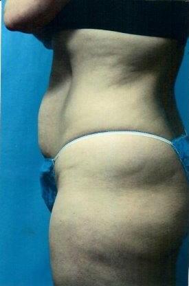 Tummy tuck Before & After Image