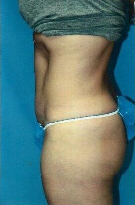 Tummy tuck Before & After Image