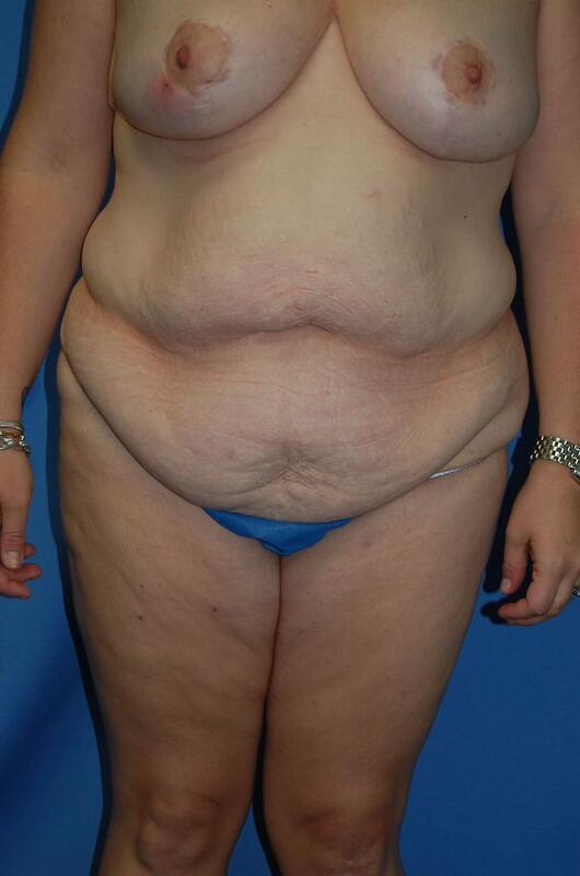 Tummy tuck Before & After Image