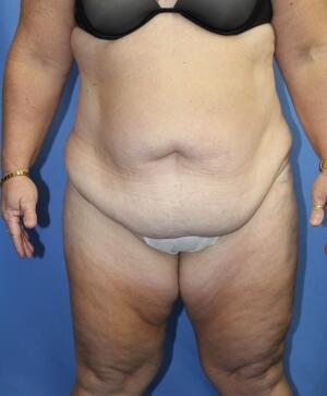 Tummy tuck Before & After Image