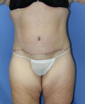 Tummy tuck Before & After Image
