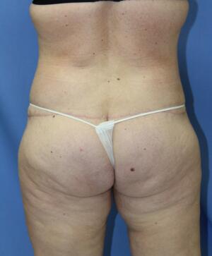 Tummy tuck Before & After Image