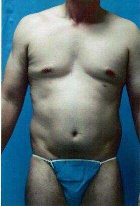 Tummy tuck Before & After Image