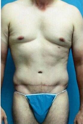 Tummy tuck Before & After Image