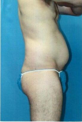 Tummy tuck Before & After Image