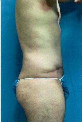 Tummy tuck Before & After Image