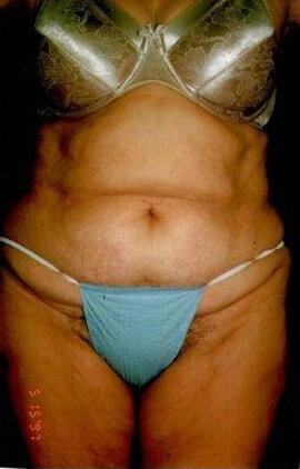 Tummy tuck Before & After Image