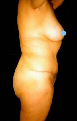 Tummy tuck Before & After Image