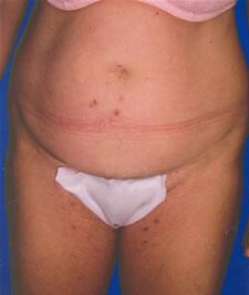 Tummy tuck Before & After Image