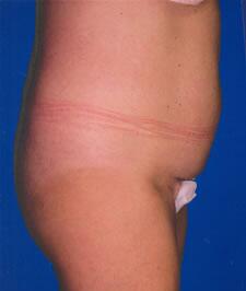 Tummy tuck Before & After Image