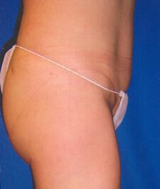 Tummy tuck Before & After Image