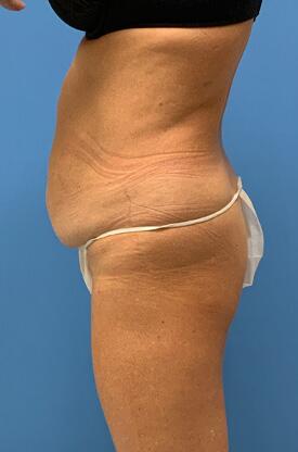 Tummy tuck Before & After Image
