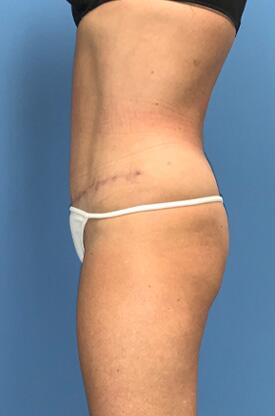 Tummy tuck Before & After Image