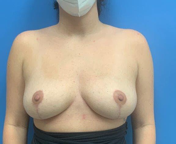 Breast implant removal Before & After Image