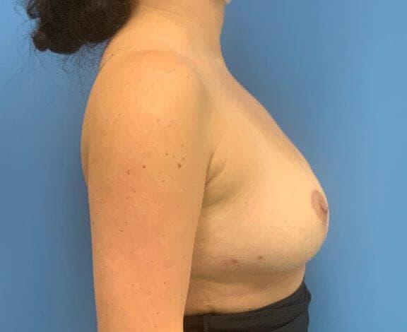 Breast implant removal Before & After Image