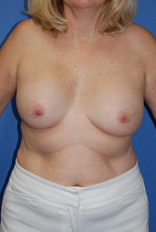Breast implant removal Before & After Image