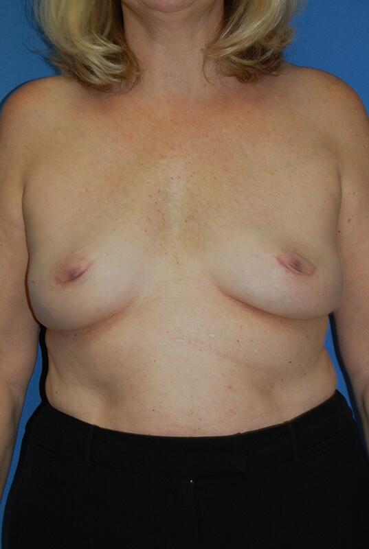 Breast implant removal Before & After Image
