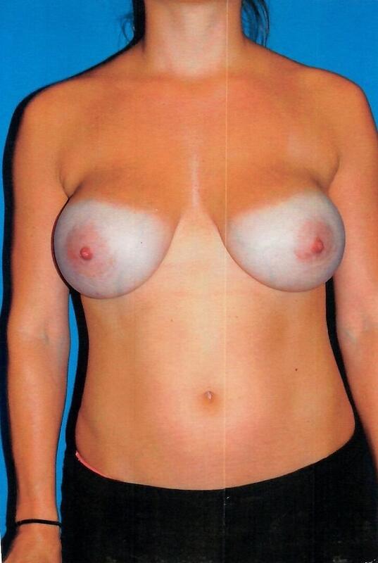 Breast implant revision Before & After Image