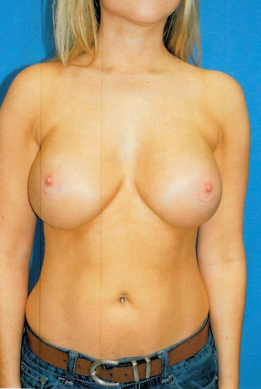 Breast implant revision Before & After Image