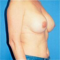 Breast implant revision Before & After Image