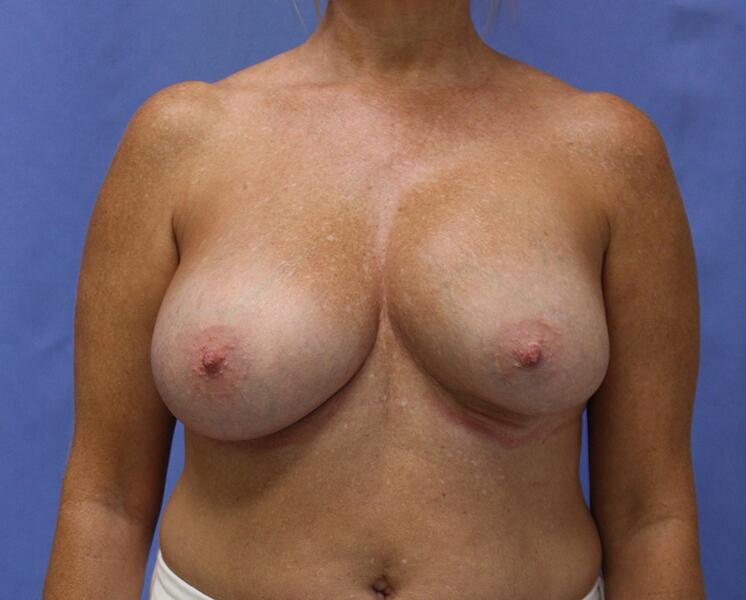 Breast implant revision Before & After Image